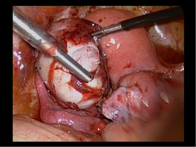 Endometriotic Choclate Ovarian Cyst Shelling off Endometriotic Choclate Ovarian Cyst Shelling off